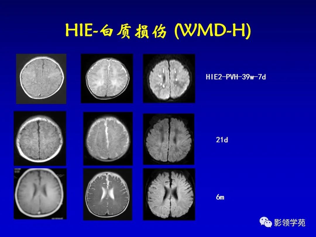 影像PPT - 新生儿颅脑MRI解剖及常见疾病影像表现-180 影像PPT - 新生儿颅脑MRI解剖及常见疾病影像表现-180