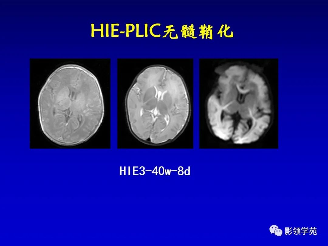 影像PPT - 新生儿颅脑MRI解剖及常见疾病影像表现-182 影像PPT - 新生儿颅脑MRI解剖及常见疾病影像表现-182