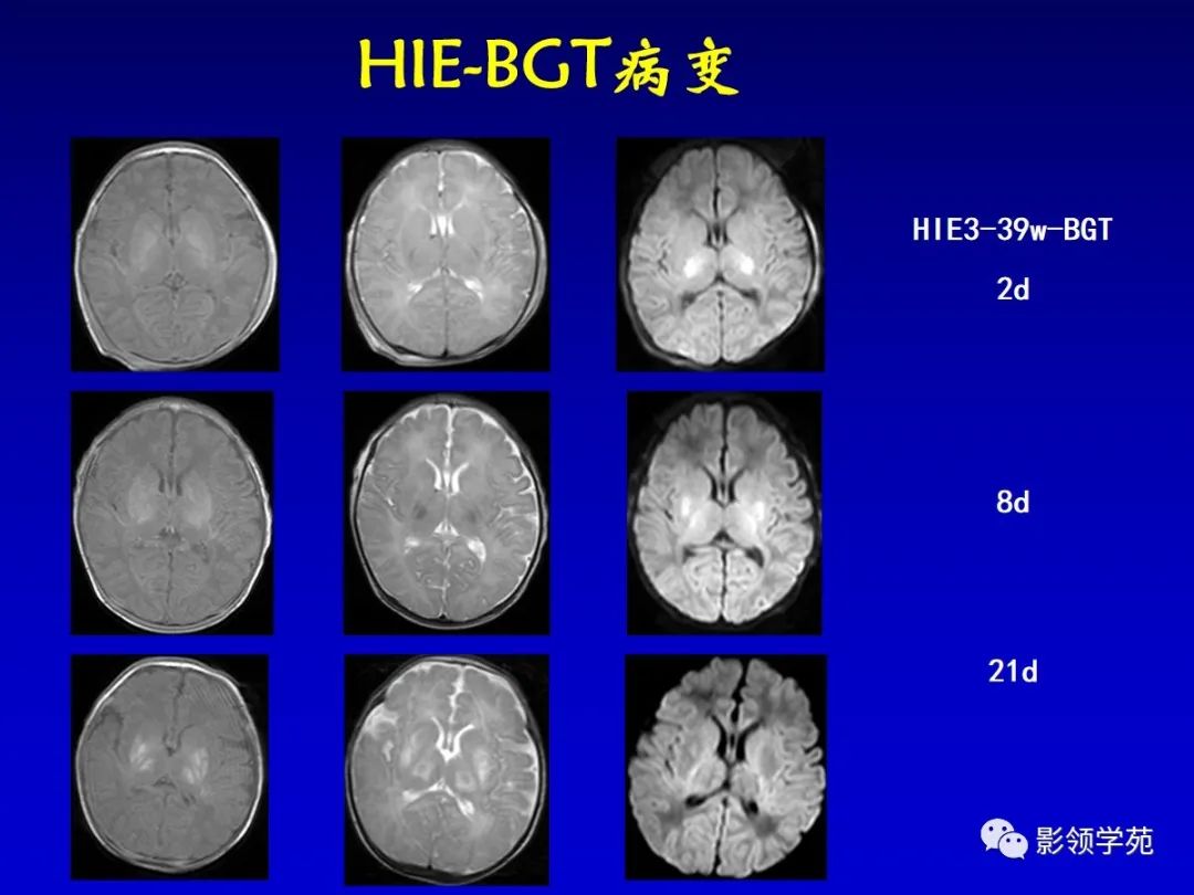 影像PPT - 新生儿颅脑MRI解剖及常见疾病影像表现-183 影像PPT - 新生儿颅脑MRI解剖及常见疾病影像表现-183