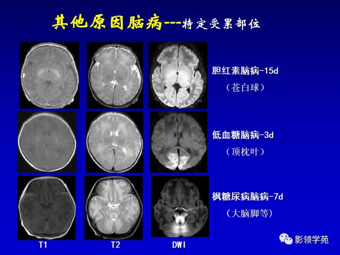 影像PPT - 新生儿颅脑MRI解剖及常见疾病影像表现-185 影像PPT - 新生儿颅脑MRI解剖及常见疾病影像表现-185