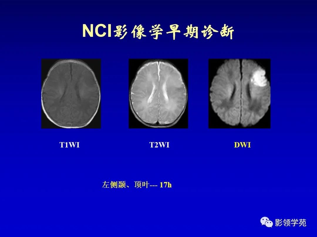 影像PPT - 新生儿颅脑MRI解剖及常见疾病影像表现-188 影像PPT - 新生儿颅脑MRI解剖及常见疾病影像表现-188