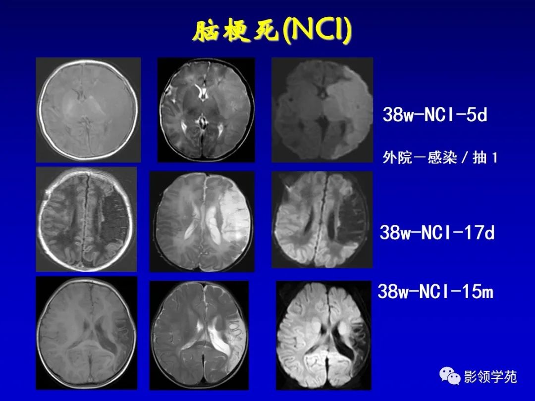 影像PPT - 新生儿颅脑MRI解剖及常见疾病影像表现-189 影像PPT - 新生儿颅脑MRI解剖及常见疾病影像表现-189