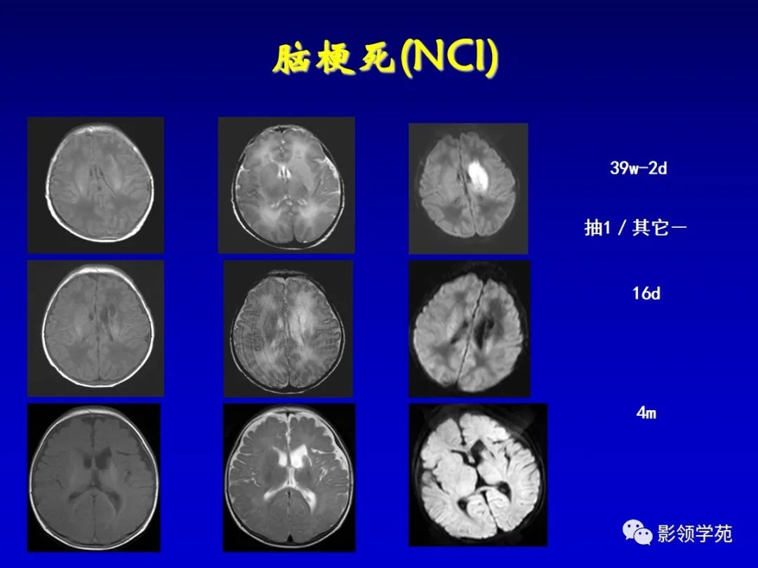 影像PPT - 新生儿颅脑MRI解剖及常见疾病影像表现-190 影像PPT - 新生儿颅脑MRI解剖及常见疾病影像表现-190