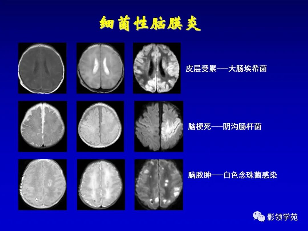 影像PPT - 新生儿颅脑MRI解剖及常见疾病影像表现-194 影像PPT - 新生儿颅脑MRI解剖及常见疾病影像表现-194