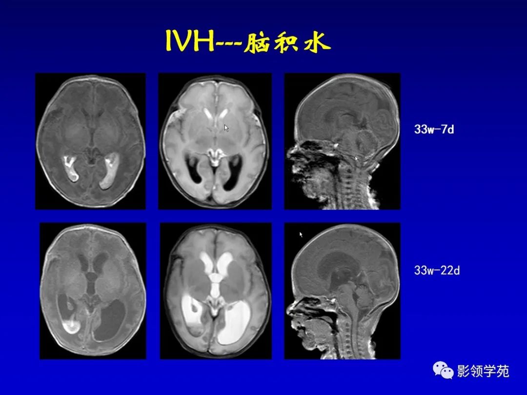 影像PPT - 新生儿颅脑MRI解剖及常见疾病影像表现-196 影像PPT - 新生儿颅脑MRI解剖及常见疾病影像表现-196