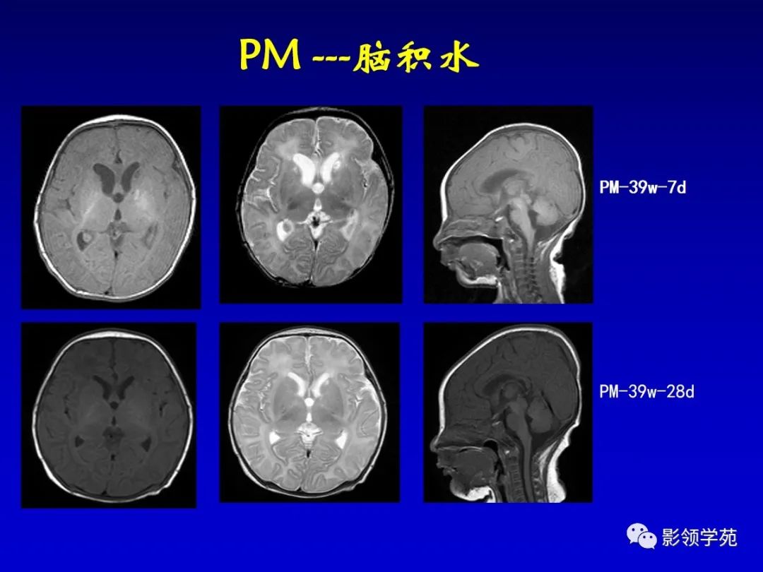 影像PPT - 新生儿颅脑MRI解剖及常见疾病影像表现-197 影像PPT - 新生儿颅脑MRI解剖及常见疾病影像表现-197