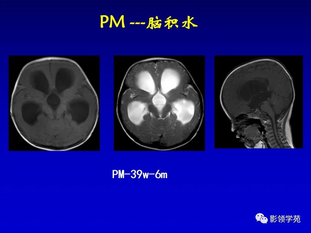 影像PPT - 新生儿颅脑MRI解剖及常见疾病影像表现-198 影像PPT - 新生儿颅脑MRI解剖及常见疾病影像表现-198
