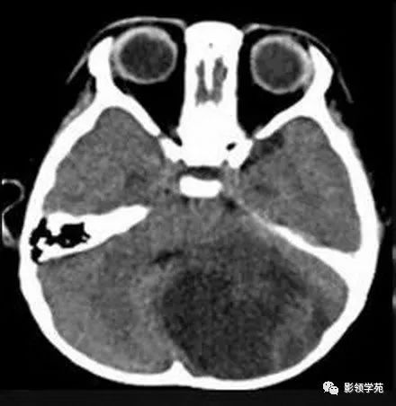 影像PPT - 【病例】小脑毛细胞型星形细胞瘤1例CT及MR-1 影像PPT - 【病例】小脑毛细胞型星形细胞瘤1例CT及MR-1
