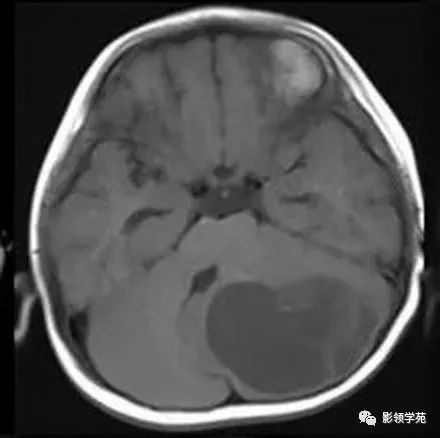 影像PPT - 【病例】小脑毛细胞型星形细胞瘤1例CT及MR-2 影像PPT - 【病例】小脑毛细胞型星形细胞瘤1例CT及MR-2