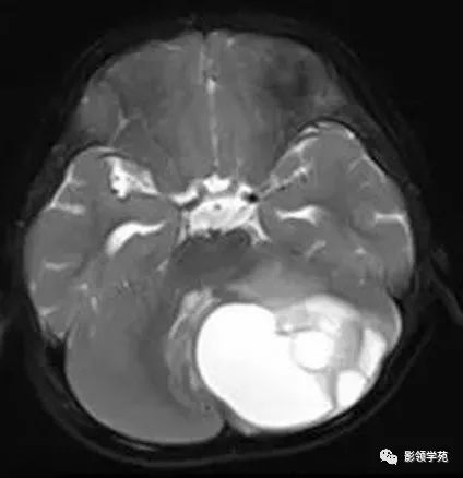 影像PPT - 【病例】小脑毛细胞型星形细胞瘤1例CT及MR-3 影像PPT - 【病例】小脑毛细胞型星形细胞瘤1例CT及MR-3
