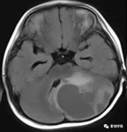 影像PPT - 【病例】小脑毛细胞型星形细胞瘤1例CT及MR-4 影像PPT - 【病例】小脑毛细胞型星形细胞瘤1例CT及MR-4