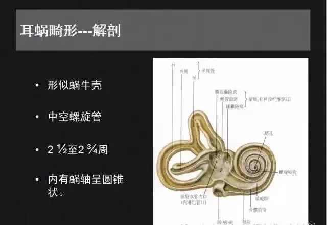 影像PPT - 【PPT】先天性内耳畸形影像学诊断-5