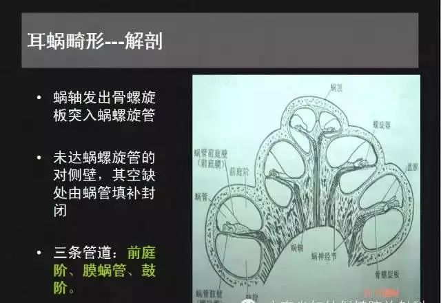 影像PPT - 【PPT】先天性内耳畸形影像学诊断-6