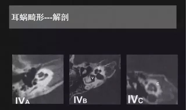 影像PPT - 【PPT】先天性内耳畸形影像学诊断-7