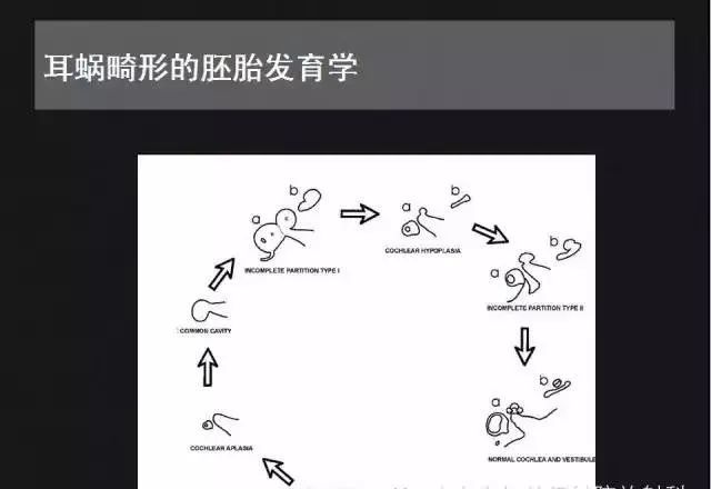 影像PPT - 【PPT】先天性内耳畸形影像学诊断-8