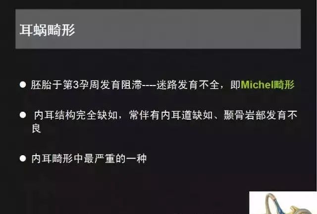 影像PPT - 【PPT】先天性内耳畸形影像学诊断-9