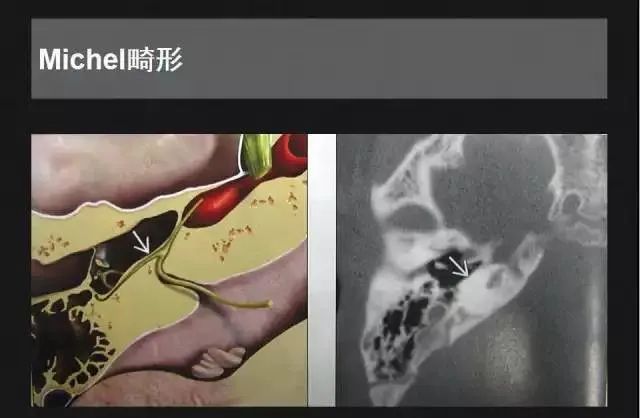 影像PPT - 【PPT】先天性内耳畸形影像学诊断-10