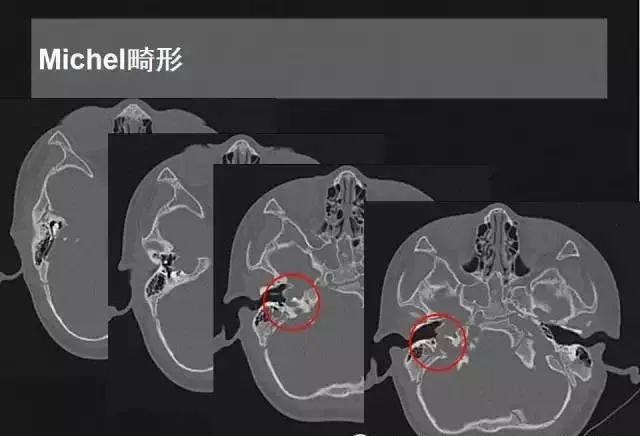 影像PPT - 【PPT】先天性内耳畸形影像学诊断-11