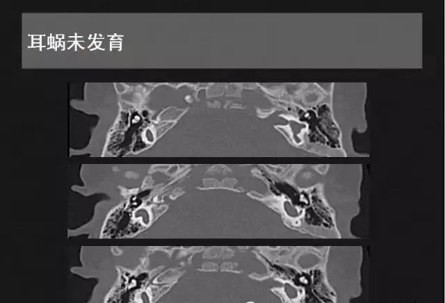 影像PPT - 【PPT】先天性内耳畸形影像学诊断-13