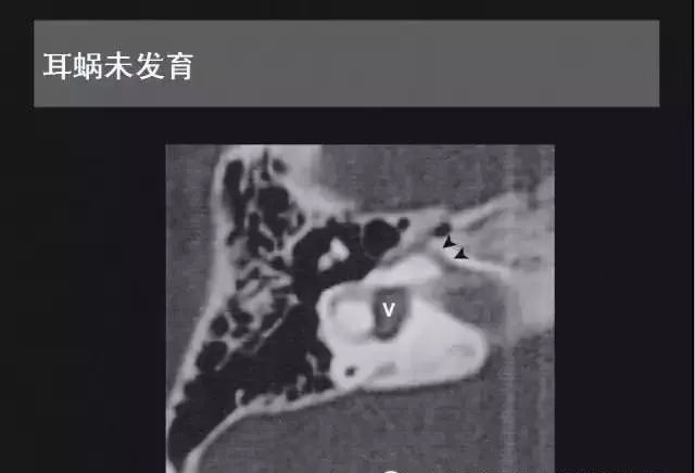 影像PPT - 【PPT】先天性内耳畸形影像学诊断-14