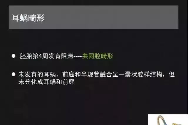 影像PPT - 【PPT】先天性内耳畸形影像学诊断-15