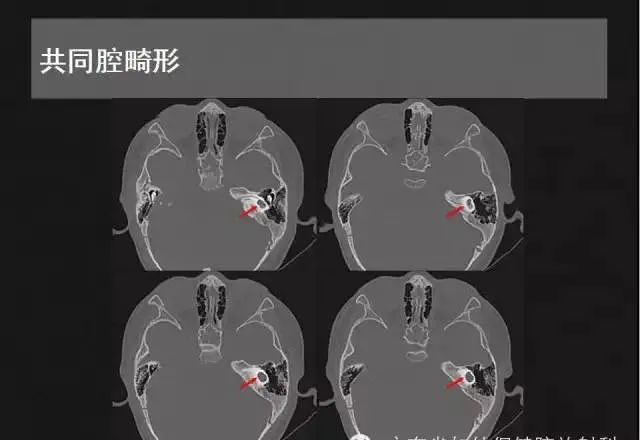 影像PPT - 【PPT】先天性内耳畸形影像学诊断-16
