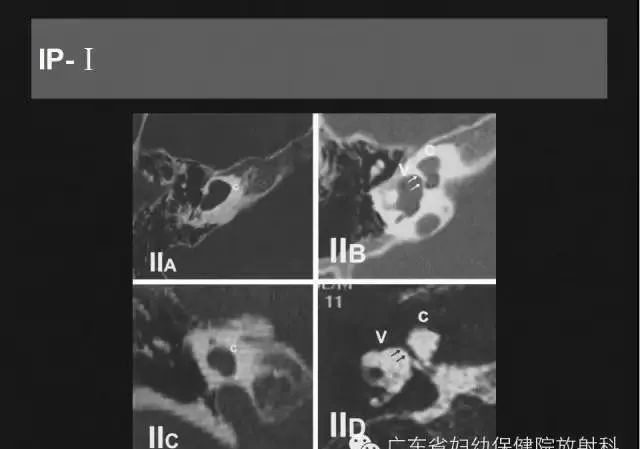 影像PPT - 【PPT】先天性内耳畸形影像学诊断-19