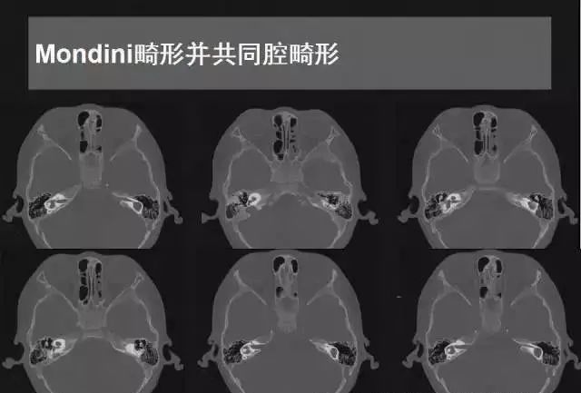 影像PPT - 【PPT】先天性内耳畸形影像学诊断-23