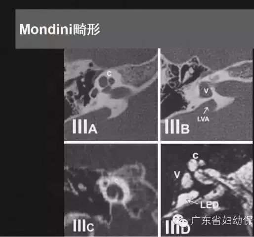 影像PPT - 【PPT】先天性内耳畸形影像学诊断-24