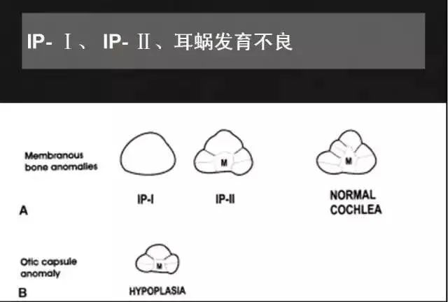 影像PPT - 【PPT】先天性内耳畸形影像学诊断-25