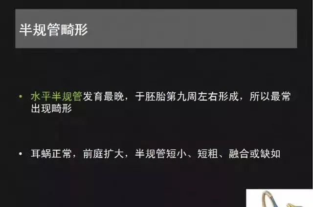 影像PPT - 【PPT】先天性内耳畸形影像学诊断-28