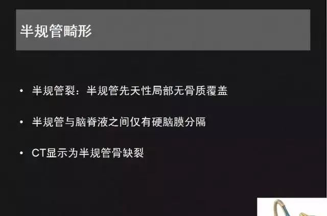 影像PPT - 【PPT】先天性内耳畸形影像学诊断-29