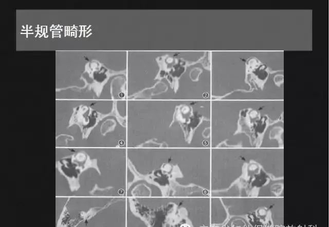 影像PPT - 【PPT】先天性内耳畸形影像学诊断-30