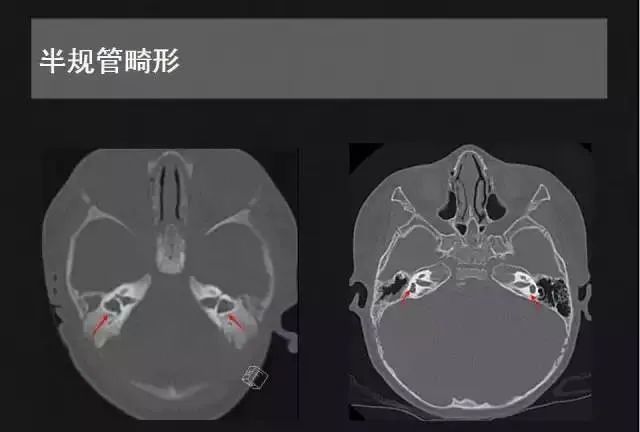 影像PPT - 【PPT】先天性内耳畸形影像学诊断-31