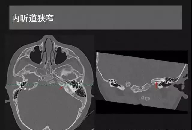 影像PPT - 【PPT】先天性内耳畸形影像学诊断-33