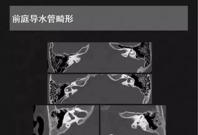 影像PPT - 【PPT】先天性内耳畸形影像学诊断-35