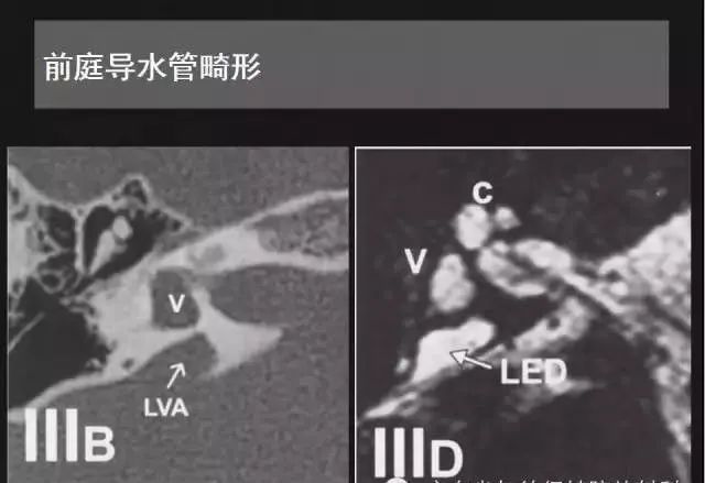 影像PPT - 【PPT】先天性内耳畸形影像学诊断-36