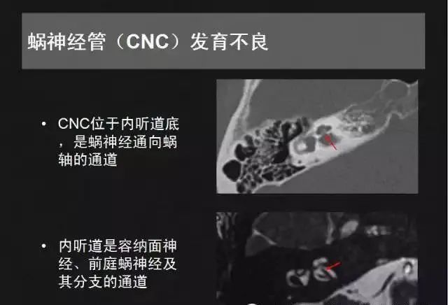 影像PPT - 【PPT】先天性内耳畸形影像学诊断-37