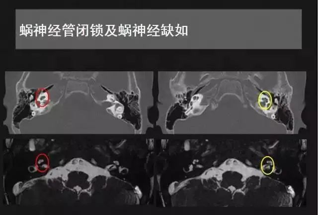 影像PPT - 【PPT】先天性内耳畸形影像学诊断-39