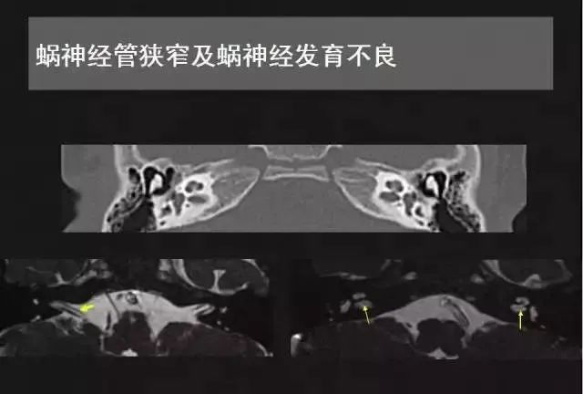 影像PPT - 【PPT】先天性内耳畸形影像学诊断-40