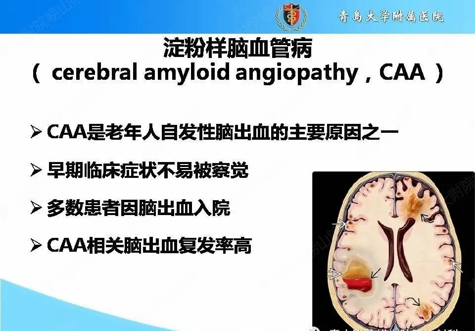影像PPT - 【PPT】淀粉样脑血管病的影像诊断与鉴别诊断-2