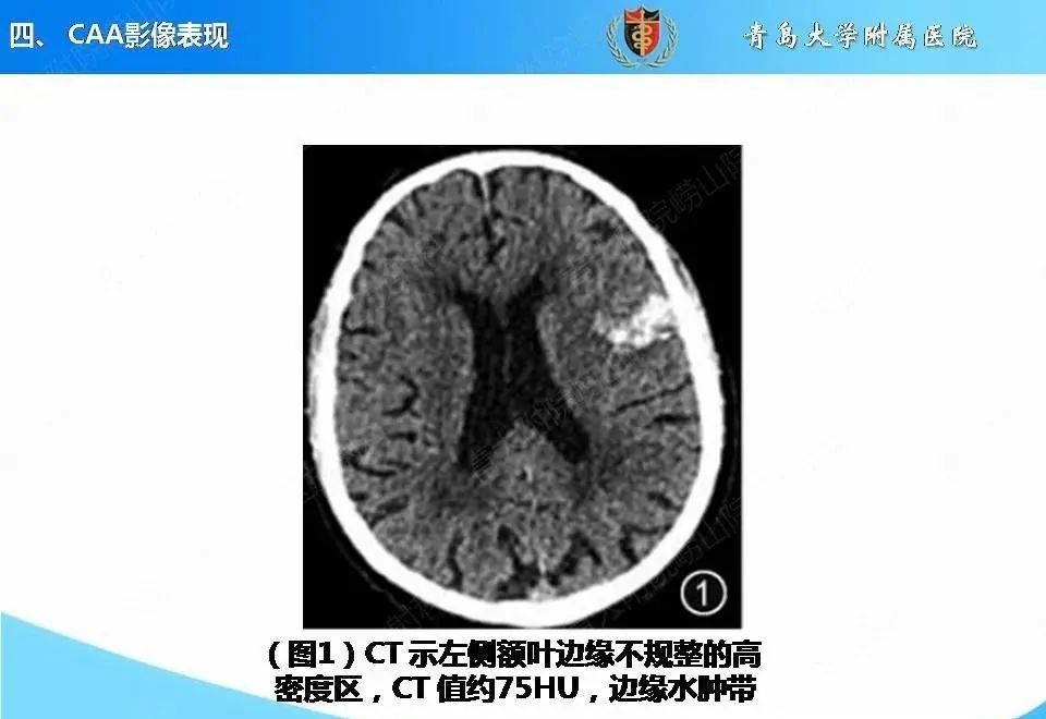 影像PPT - 【PPT】淀粉样脑血管病的影像诊断与鉴别诊断-25