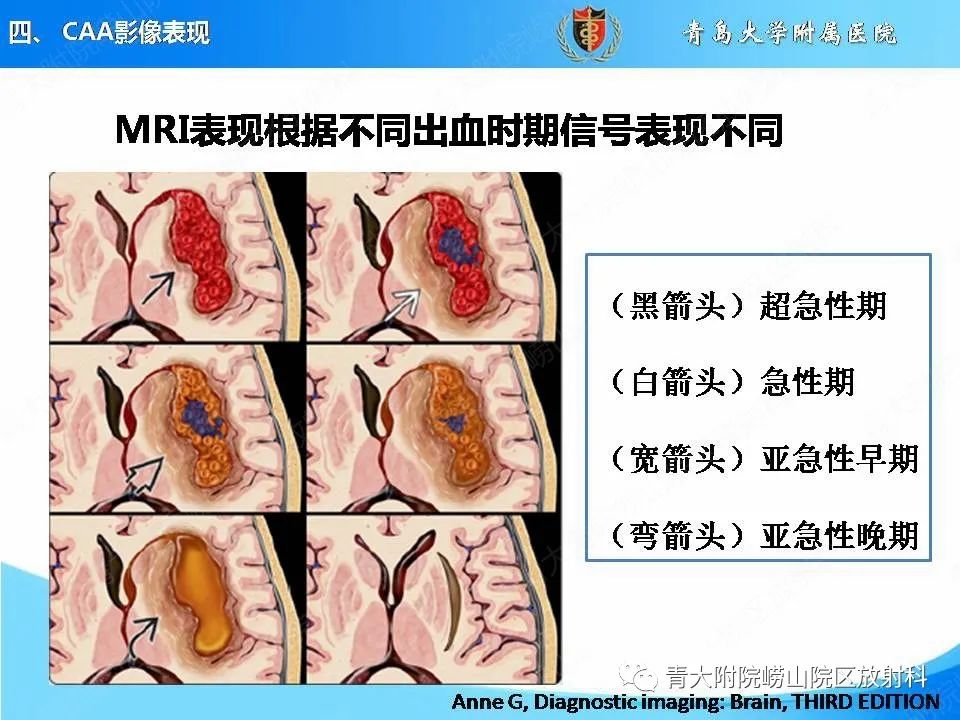 影像PPT - 【PPT】淀粉样脑血管病的影像诊断与鉴别诊断-27