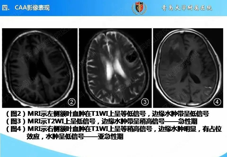 影像PPT - 【PPT】淀粉样脑血管病的影像诊断与鉴别诊断-29
