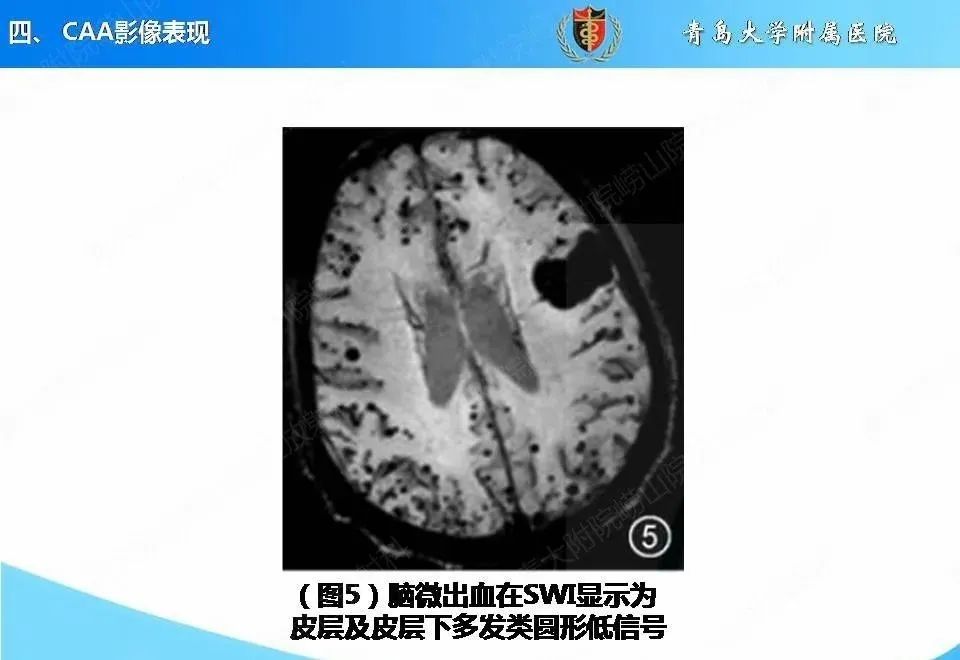 影像PPT - 【PPT】淀粉样脑血管病的影像诊断与鉴别诊断-33