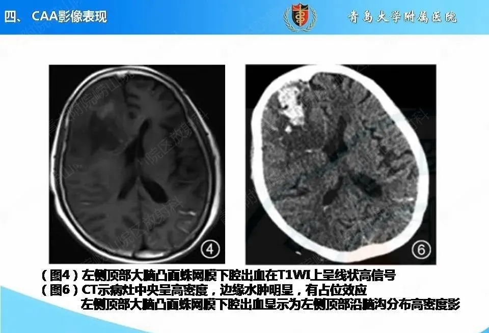 影像PPT - 【PPT】淀粉样脑血管病的影像诊断与鉴别诊断-35