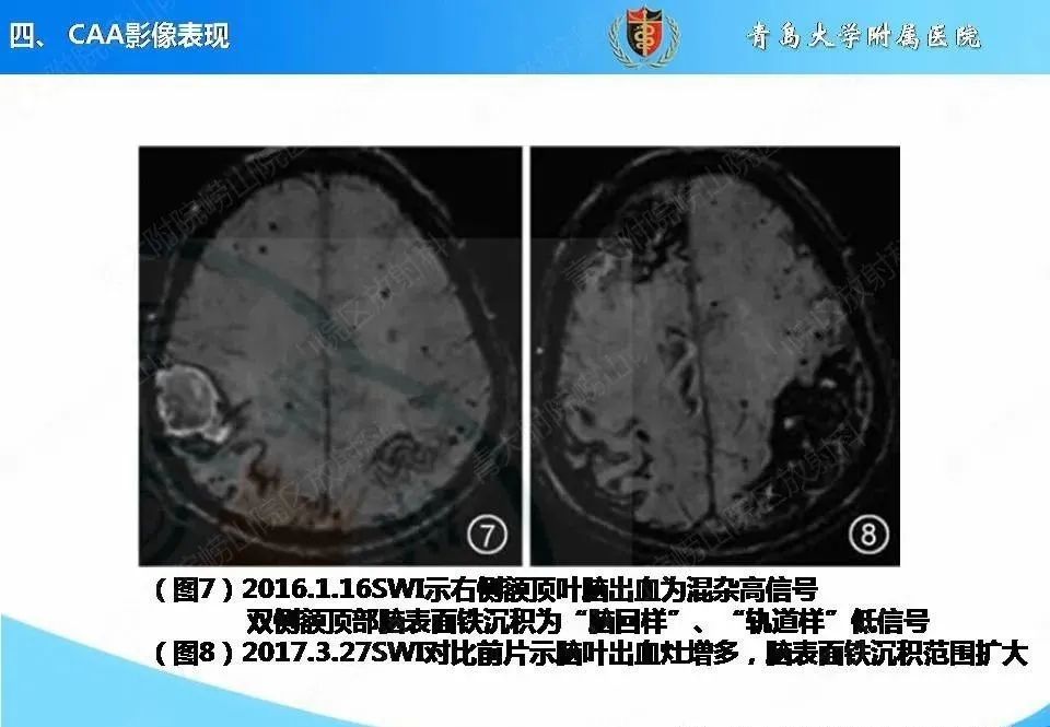 影像PPT - 【PPT】淀粉样脑血管病的影像诊断与鉴别诊断-37