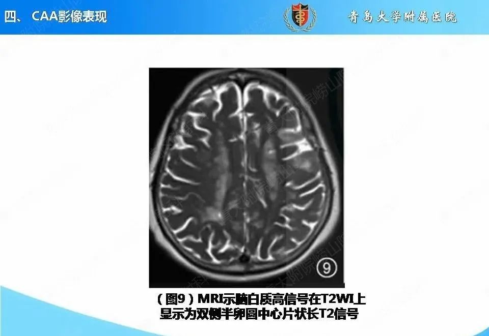 影像PPT - 【PPT】淀粉样脑血管病的影像诊断与鉴别诊断-43