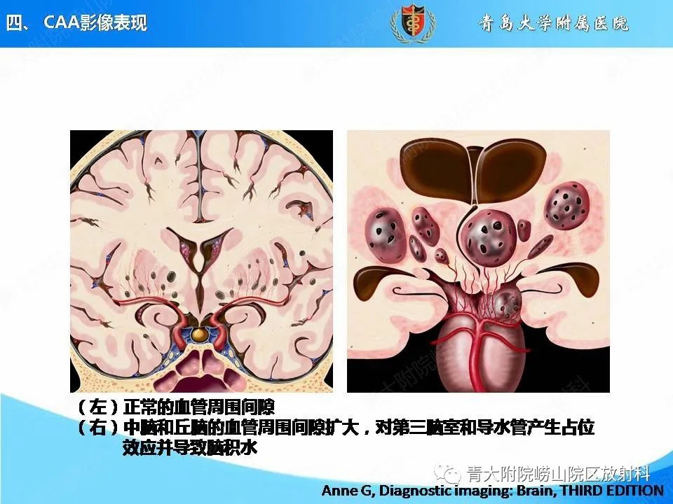 影像PPT - 【PPT】淀粉样脑血管病的影像诊断与鉴别诊断-45