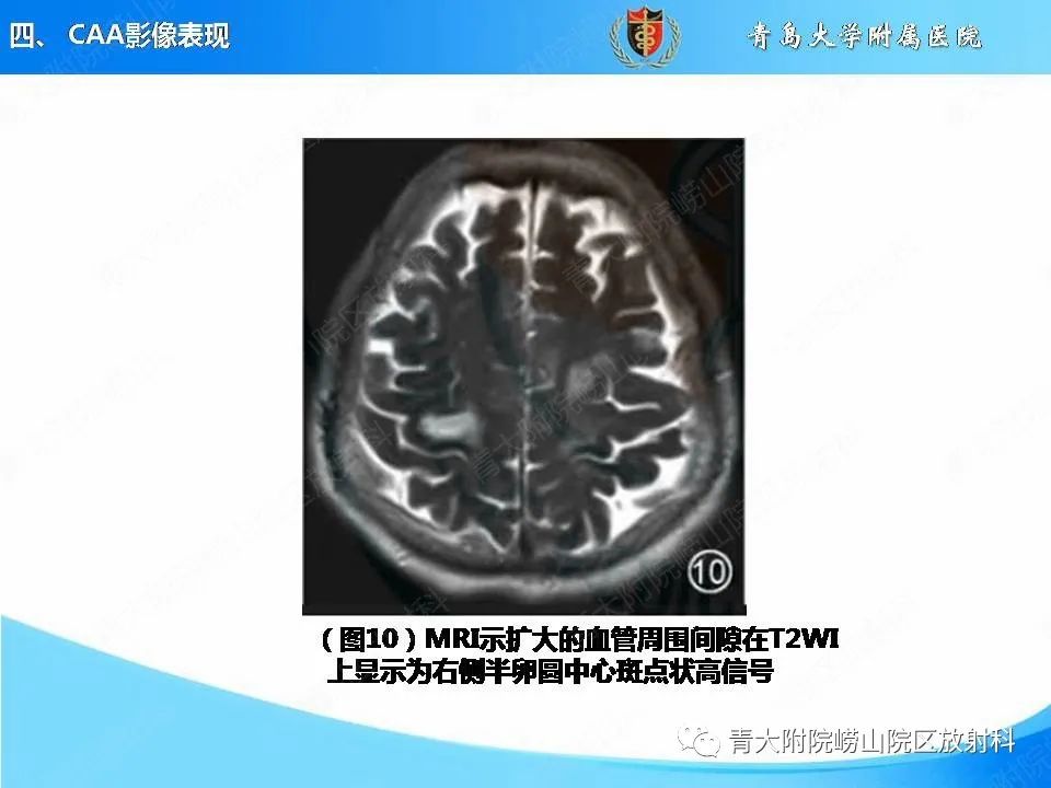 影像PPT - 【PPT】淀粉样脑血管病的影像诊断与鉴别诊断-46